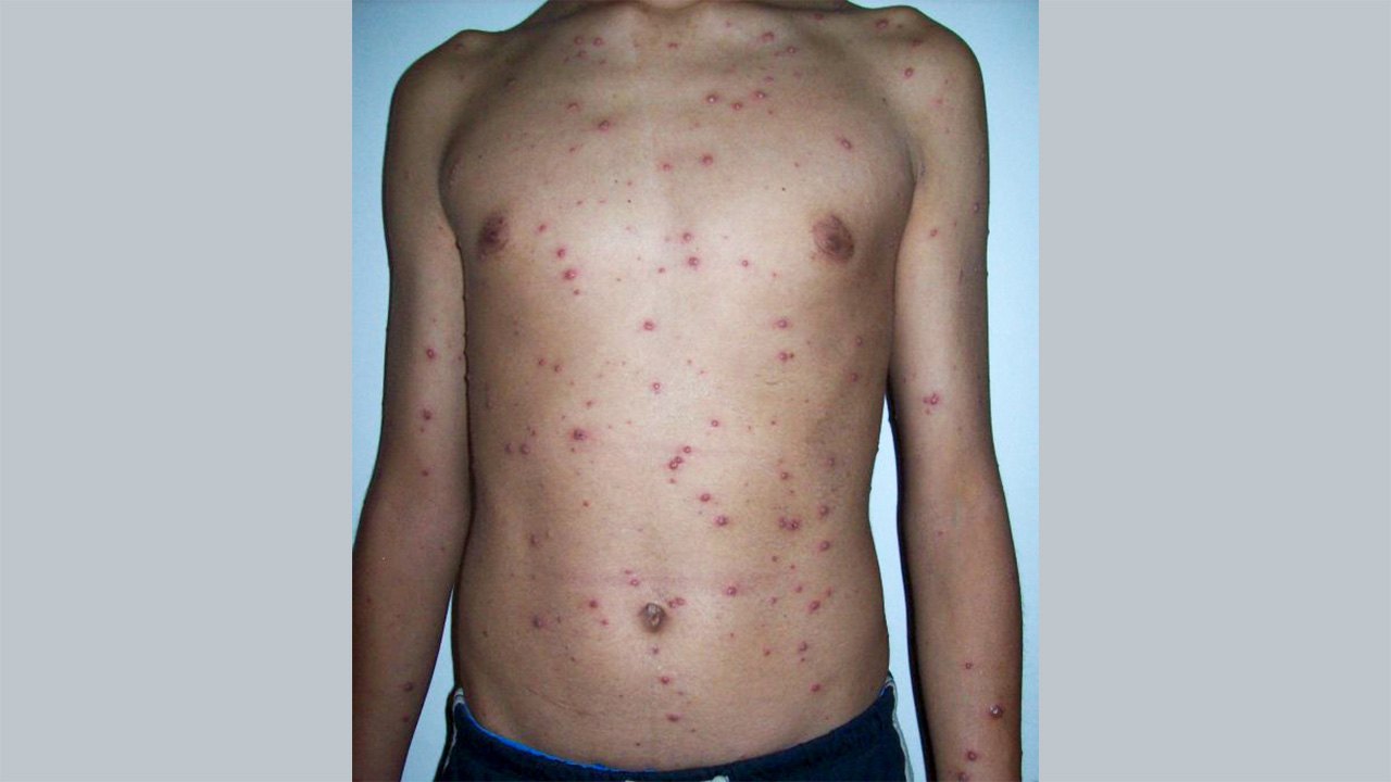 A photo of a bare torso covered in chickenpox